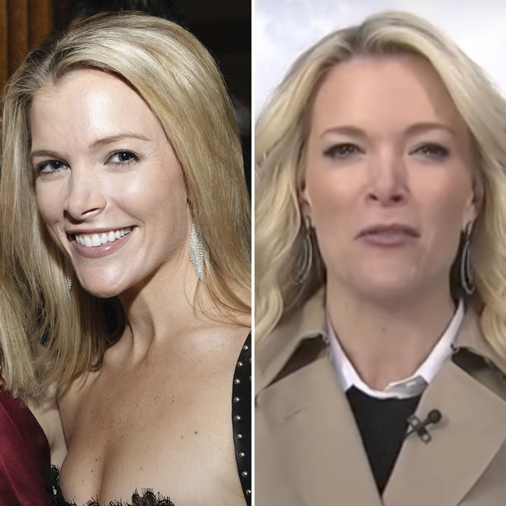 Has TV Star Megyn Kelly Gotten Plastic Surgery? Experts Weigh In!