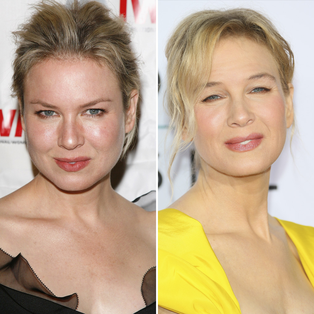 Renée Zellweger's Plastic Surgery Gets Weighed in on by Experts