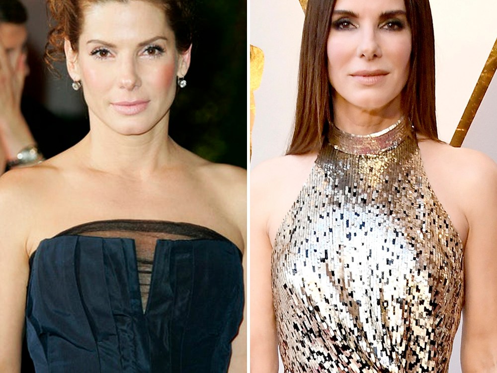 Sandra Bullock Plastic Surgery — Experts Weigh In On Her Botox