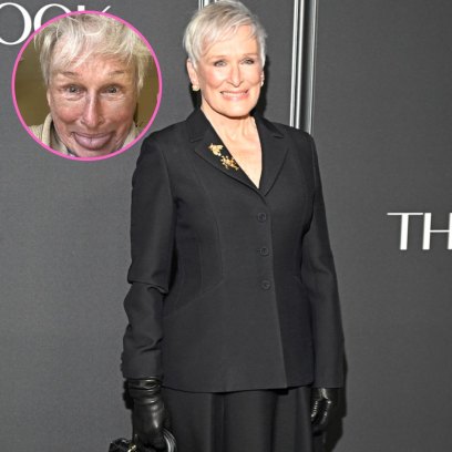 glenn close shows off bruised face after breaking her nose