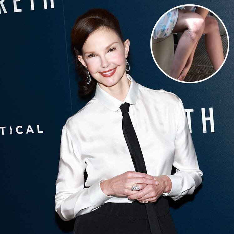 Ashley Judd Recalls Leg Injury That Almost Led to Amputation