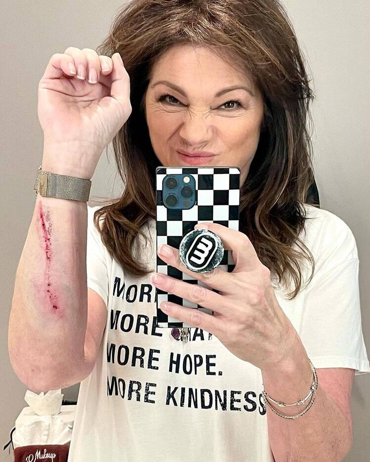 Valerie Bertinelli Reveals Gruesome Arm Injury
